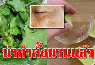 ฝ้าหนา กระแดดขึ้น แก้ด้วย 5 วิธีง่ายๆลดเลือนให้รอยหายไป